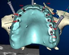 Hapkedent navigierte Implantologie
